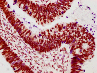 IHC image diluted at 1:100 and staining in paraffin-embedded human ovarian cancer performed on a Leica BondTM system. After dewaxing and hydration, antigen retrieval was mediated by high pressure in a citrate buffer (pH 6.0). Section was blocked with 10% normal goat serum 30min at RT. Then primary antibody (1% BSA) was incubated at 4? overnight. The primary is detected by a biotinylated secondary antibody and visualized using an HRP conjugated SP system.