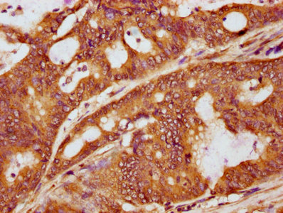 IHC image diluted at 1:100 and staining in paraffin-embedded human colon cancer performed on a Leica BondTM system. After dewaxing and hydration, antigen retrieval was mediated by high pressure in a citrate buffer (pH 6.0). Section was blocked with 10% normal goat serum 30min at RT. Then primary antibody (1% BSA) was incubated at 4Â°C overnight. The primary is detected by a biotinylated secondary antibody and visualized using an HRP conjugated SP system.
