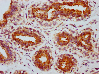 IHC image diluted at 1:100 and staining in paraffin-embedded human breast cancer performed on a Leica BondTM system. After dewaxing and hydration, antigen retrieval was mediated by high pressure in a citrate buffer (pH 6.0). Section was blocked with 10% normal goat serum 30min at RT. Then primary antibody (1% BSA) was incubated at 4? overnight. The primary is detected by a biotinylated secondary antibody and visualized using an HRP conjugated SP system.