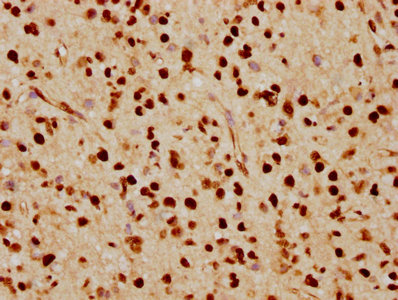 IHC image diluted at 1:70 and staining in paraffin-embedded human glioma cancer performed on a Leica BondTM system. After dewaxing and hydration, antigen retrieval was mediated by high pressure in a citrate buffer (pH 6.0). Section was blocked with 10% normal goat serum 30min at RT. Then primary antibody (1% BSA) was incubated at 4? overnight. The primary is detected by a biotinylated secondary antibody and visualized using an HRP conjugated SP system.