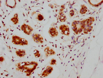 IHC image diluted at 1:205 and staining in paraffin-embedded human breast cancer performed on a Leica BondTM system. After dewaxing and hydration, antigen retrieval was mediated by high pressure in a citrate buffer (pH 6.0). Section was blocked with 10% normal goat serum 30min at RT. Then primary antibody (1% BSA) was incubated at 4? overnight. The primary is detected by a biotinylated secondary antibody and visualized using an HRP conjugated SP system.