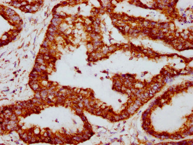 IHC image diluted at 1:117 and staining in paraffin-embedded human colon cancer performed on a Leica BondTM system. After dewaxing and hydration, antigen retrieval was mediated by high pressure in a citrate buffer (pH 6.0). Section was blocked with 10% normal goat serum 30min at RT. Then primary antibody (1% BSA) was incubated at 4? overnight. The primary is detected by a biotinylated secondary antibody and visualized using an HRP conjugated SP system.