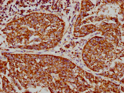 IHC image diluted at 1:73.125 and staining in paraffin-embedded human cervical cancer performed on a Leica BondTM system. After dewaxing and hydration, antigen retrieval was mediated by high pressure in a citrate buffer (pH 6.0). Section was blocked with 10% normal goat serum 30min at RT. Then primary antibody (1% BSA) was incubated at 4? overnight. The primary is detected by a biotinylated secondary antibody and visualized using an HRP conjugated SP system.
