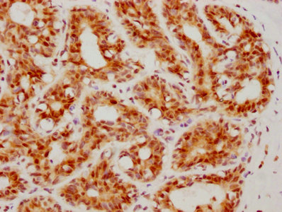 IHC image diluted at 1:160 and staining in paraffin-embedded human breast cancer performed on a Leica BondTM system. After dewaxing and hydration, antigen retrieval was mediated by high pressure in a citrate buffer (pH 6.0). Section was blocked with 10% normal goat serum 30min at RT. Then primary antibody (1% BSA) was incubated at 4? overnight. The primary is detected by a biotinylated secondary antibody and visualized using an HRP conjugated SP system.