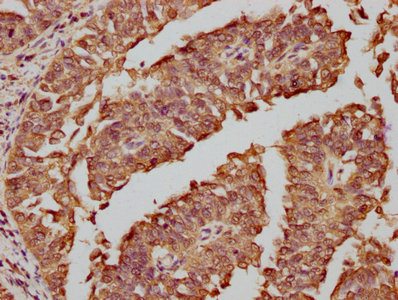 IHC image diluted at 1:81 and staining in paraffin-embedded human cervical cancer performed on a Leica BondTM system. After dewaxing and hydration, antigen retrieval was mediated by high pressure in a citrate buffer (pH 6.0). Section was blocked with 10% normal goat serum 30min at RT. Then primary antibody (1% BSA) was incubated at 4? overnight. The primary is detected by a biotinylated secondary antibody and visualized using an HRP conjugated SP system.