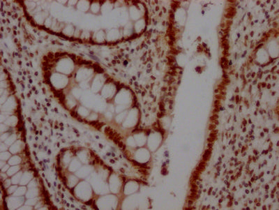 IHC image diluted at 1:100 and staining in paraffin-embedded human colon cancer performed on a Leica BondTM system. After dewaxing and hydration, antigen retrieval was mediated by high pressure in a citrate buffer (pH 6.0). Section was blocked with 10% normal goat serum 30min at RT. Then primary antibody (1% BSA) was incubated at 4? overnight. The primary is detected by a Goat anti-rabbit IgG polymer labeled by HRP and visualized using 0.05% DAB.