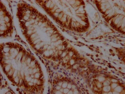 IHC image diluted at 1:100 and staining in paraffin-embedded human colon cancer performed on a Leica BondTM system. After dewaxing and hydration, antigen retrieval was mediated by high pressure in a citrate buffer (pH 6.0). Section was blocked with 10% normal goat serum 30min at RT. Then primary antibody (1% BSA) was incubated at 4? overnight. The primary is detected by a Goat anti-rabbit IgG polymer labeled by HRP and visualized using 0.05% DAB.