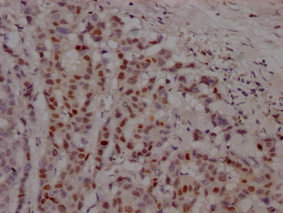 IHC image diluted at 1:100 and staining in paraffin-embedded human breast cancer performed on a Leica BondTM system. After dewaxing and hydration, antigen retrieval was mediated by high pressure in a citrate buffer (pH 6.0). Section was blocked with 10% normal goat serum 30min at RT. Then primary antibody (1% BSA) was incubated at 4? overnight. The primary is detected by a Goat anti-rabbit IgG polymer labeled by HRP and visualized using 0.05% DAB.