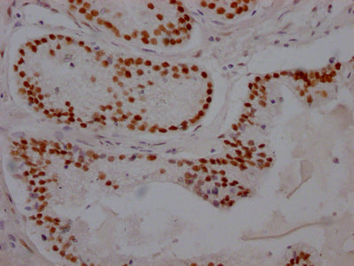 IHC image diluted at 1:100 and staining in paraffin-embedded human prostate cancer performed on a Leica BondTM system. After dewaxing and hydration, antigen retrieval was mediated by high pressure in a citrate buffer (pH 6.0). Section was blocked with 10% normal goat serum 30min at RT. Then primary antibody (1% BSA) was incubated at 4? overnight. The primary is detected by a Goat anti-rabbit IgG polymer labeled by HRP and visualized using 0.05% DAB.