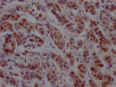 IHC image diluted at 1:100 and staining in paraffin-embedded human breast cancer performed on a Leica BondTM system. After dewaxing and hydration, antigen retrieval was mediated by high pressure in a citrate buffer (pH 6.0). Section was blocked with 10% normal goat serum 30min at RT. Then primary antibody (1% BSA) was incubated at 4? overnight. The primary is detected by a Goat anti-rabbit IgG polymer labeled by HRP and visualized using 0.05% DAB.