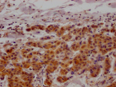 IHC image diluted at 1:100 and staining in paraffin-embedded human breast cancer performed on a Leica BondTM system. After dewaxing and hydration, antigen retrieval was mediated by high pressure in a citrate buffer (pH 6.0). Section was blocked with 10% normal goat serum 30min at RT. Then primary antibody (1% BSA) was incubated at 4? overnight. The primary is detected by a Goat anti-rabbit IgG polymer labeled by HRP and visualized using 0.05% DAB.