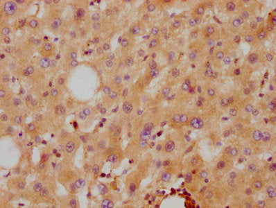 IHC image diluted at 1:87.5 and staining in paraffin-embedded human liver tissue performed on a Leica BondTM system. After dewaxing and hydration, antigen retrieval was mediated by high pressure in a citrate buffer (pH 6.0). Section was blocked with 10% normal goat serum 30min at RT. Then primary antibody (1% BSA) was incubated at 4? overnight. The primary is detected by a biotinylated secondary antibody and visualized using an HRP conjugated SP system.