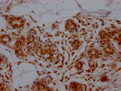IHC image diluted at 1:100 and staining in paraffin-embedded human breast cancer performed on a Leica BondTM system. After dewaxing and hydration, antigen retrieval was mediated by high pressure in a citrate buffer (pH 6.0). Section was blocked with 10% normal goat serum 30min at RT. Then primary antibody (1% BSA) was incubated at 4? overnight. The primary is detected by a Goat anti-rabbit IgG polymer labeled by HRP and visualized using 0.05% DAB.