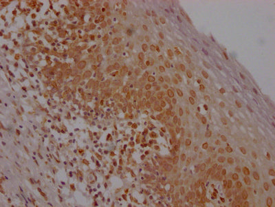 IHC image diluted at 1:100 and staining in paraffin-embedded human tonsil tissue performed on a Leica BondTM system. After dewaxing and hydration, antigen retrieval was mediated by high pressure in a citrate buffer (pH 6.0). Section was blocked with 10% normal goat serum 30min at RT. Then primary antibody (1% BSA) was incubated at 4? overnight. The primary is detected by a Goat anti-rabbit IgG polymer labeled by HRP and visualized using 0.05% DAB.