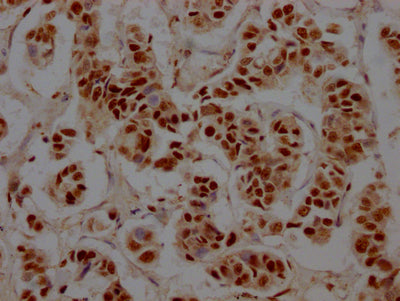 IHC image diluted at 1:100 and staining in paraffin-embedded human breast cancer performed on a Leica BondTM system. After dewaxing and hydration, antigen retrieval was mediated by high pressure in a citrate buffer (pH 6.0). Section was blocked with 10% normal goat serum 30min at RT. Then primary antibody (1% BSA) was incubated at 4? overnight. The primary is detected by a Goat anti-rabbit IgG polymer labeled by HRP and visualized using 0.05% DAB.