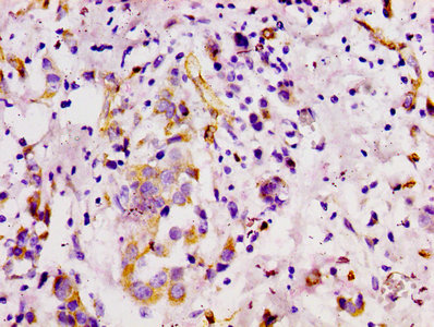 IHC image of RAC07076 diluted at 1:100 and staining in paraffin-embedded human breast cancer performed on a Leica BondTM system. After dewaxing and hydration, antigen retrieval was mediated by high pressure in a citrate buffer (pH 6.0). Section was blocked with 10% normal goat serum 30min at RT. Then primary antibody (1% BSA) was incubated at 4? overnight. The primary is detected by a biotinylated secondary antibody and visualized using an HRP conjugated SP system.