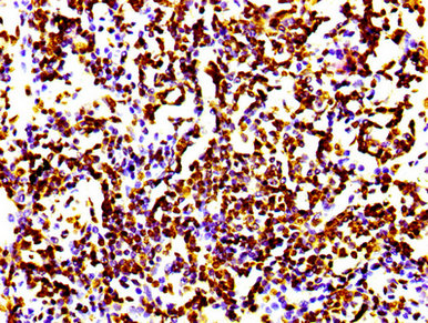 IHC image of RAC07106 diluted at 1:100 and staining in paraffin-embedded human lung cancer performed on a Leica BondTM system. After dewaxing and hydration, antigen retrieval was mediated by high pressure in a citrate buffer (pH 6.0). Section was blocked with 10% normal goat serum 30min at RT. Then primary antibody (1% BSA) was incubated at 4? overnight. The primary is detected by a biotinylated secondary antibody and visualized using an HRP conjugated SP system.