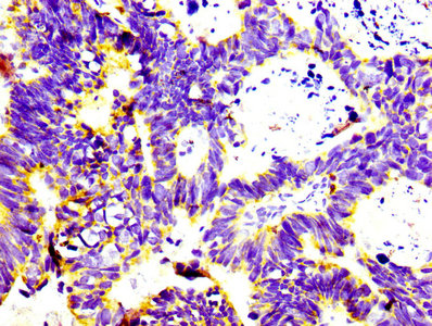 IHC image of RAC07108 diluted at 1:100 and staining in paraffin-embedded human ovarian cancer performed on a Leica BondTM system. After dewaxing and hydration, antigen retrieval was mediated by high pressure in a citrate buffer (pH 6.0). Section was blocked with 10% normal goat serum 30min at RT. Then primary antibody (1% BSA) was incubated at 4Â°C overnight. The primary is detected by a biotinylated secondary antibody and visualized using an HRP conjugated SP system.