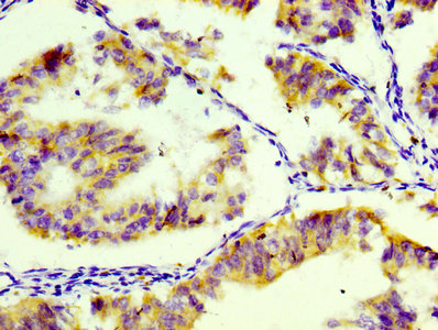 IHC image of RAC07108 diluted at 1:100 and staining in paraffin-embedded human endometrial tissue performed on a Leica BondTM system. After dewaxing and hydration, antigen retrieval was mediated by high pressure in a citrate buffer (pH 6.0). Section was blocked with 10% normal goat serum 30min at RT. Then primary antibody (1% BSA) was incubated at 4Â°C overnight. The primary is detected by a biotinylated secondary antibody and visualized using an HRP conjugated SP system.