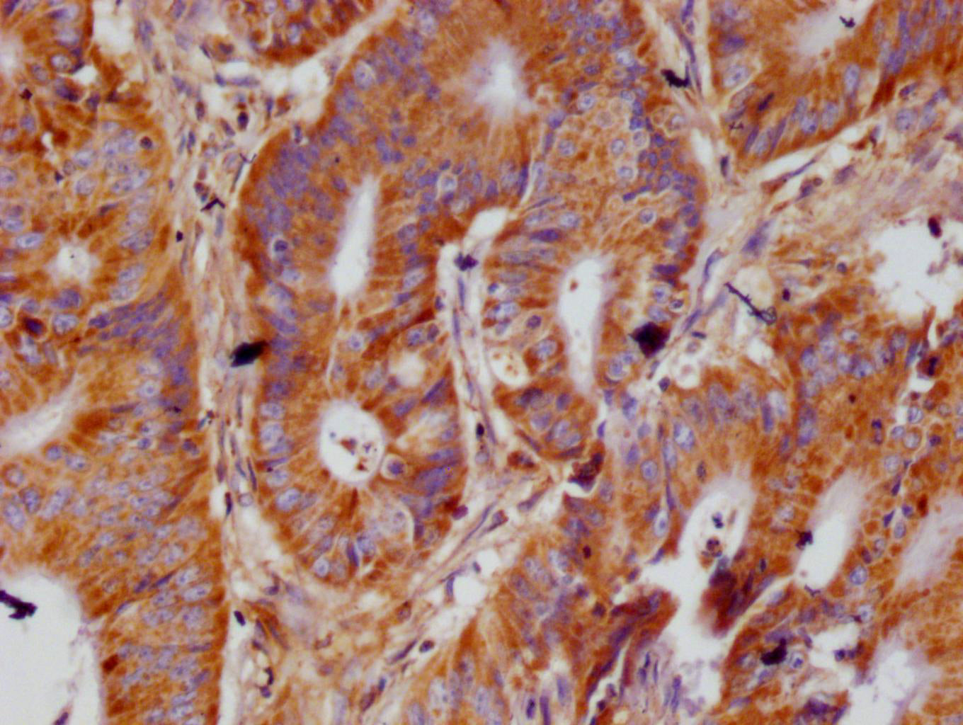IHC image of RAC07118 diluted at 1:100 and staining in paraffin-embedded human colon cancer performed on a Leica BondTM system. After dewaxing and hydration, antigen retrieval was mediated by high pressure in a citrate buffer (pH 6.0). Section was blocked with 10% normal goat serum 30min at RT. Then primary antibody (1% BSA) was incubated at 4Â°C overnight. The primary is detected by a Goat anti-rabbit polymer IgG labeled by HRP and visualized using 0.05% DAB.