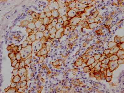 IHC image of RAC07119 diluted at 1:100 and staining in paraffin-embedded human lung tissue performed on a Leica BondTM system. After dewaxing and hydration, antigen retrieval was mediated by high pressure in a citrate buffer (pH 6.0). Section was blocked with 10% normal goat serum 30min at RT. Then primary antibody (1% BSA) was incubated at 4? overnight. The primary is detected by a Goat anti-rabbit IgG polymer labeled by HRP and visualized using 0.05% DAB.