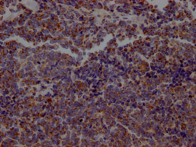 IHC image of RAC07121 diluted at 1:100 and staining in paraffin-embedded human lung cancer performed on a Leica BondTM system. After dewaxing and hydration, antigen retrieval was mediated by high pressure in a citrate buffer (pH 6.0). Section was blocked with 10% normal goat serum 30min at RT. Then primary antibody (1% BSA) was incubated at 4? overnight. The primary is detected by a Goat anti-rabbit IgG polymer labeled by HRP and visualized using 0.05% DAB.