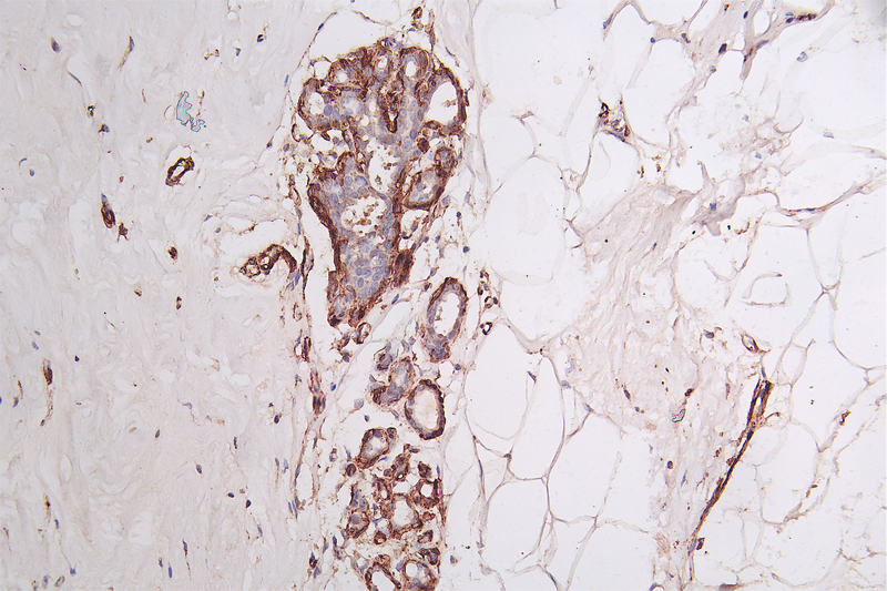 IHC image diluted at 1:50 and staining in paraffin-embedded human breast cancer performed on a Leica BondTM system. After dewaxing and hydration, antigen retrieval was mediated by high pressure in a citrate buffer (pH 6.0). Section was blocked with 10% normal goat serum 30min at RT. Then primary antibody (1% BSA) was incubated at 4Â°C overnight. The primary is detected by a Goat anti-rabbit polymer IgG labeled by HRP and visualized using 0.72% DAB.