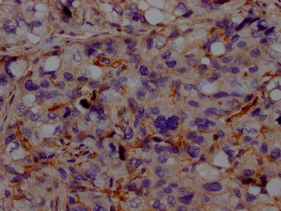 IHC image of RAC07125 diluted at 1:100 and staining in paraffin-embedded human liver cancer performed on a Leica BondTM system. After dewaxing and hydration, antigen retrieval was mediated by high pressure in a citrate buffer (pH 6.0). Section was blocked with 10% normal goat serum 30min at RT. Then primary antibody (1% BSA) was incubated at 4? overnight. The primary is detected by a Goat anti-rabbit IgG polymer labeled by HRP and visualized using 0.05% DAB.