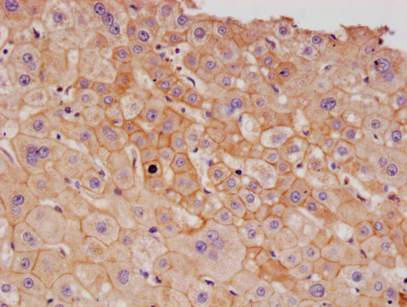 IHC image of RAC07138 diluted at 1:100 and staining in paraffin-embedded human liver cancer performed on a Leica BondTM system. After dewaxing and hydration, antigen retrieval was mediated by high pressure in a citrate buffer (pH 6.0). Section was blocked with 10% normal goat serum 30min at RT. Then primary antibody (1% BSA) was incubated at 4Â°C overnight. The primary is detected by a Goat anti-rabbit polymer IgG labeled by HRP and visualized using 0.05% DAB.