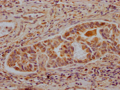IHC image of RAC07139 diluted at 1:100 and staining in paraffin-embedded human liver cancer performed on a Leica BondTM system. After dewaxing and hydration, antigen retrieval was mediated by high pressure in a citrate buffer (pH 6.0). Section was blocked with 10% normal goat serum 30min at RT. Then primary antibody (1% BSA) was incubated at 4? overnight. The primary is detected by a Goat anti-rabbit IgG polymer labeled by HRP and visualized using 0.05% DAB.