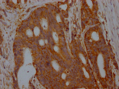 IHC image of RAC07140 diluted at 1:100 and staining in paraffin-embedded human colon cancer performed on a Leica BondTM system. After dewaxing and hydration, antigen retrieval was mediated by high pressure in a citrate buffer (pH 6.0). Section was blocked with 10% normal goat serum 30min at RT. Then primary antibody (1% BSA) was incubated at 4? overnight. The primary is detected by a Goat anti-rabbit IgG polymer labeled by HRP and visualized using 0.05% DAB.