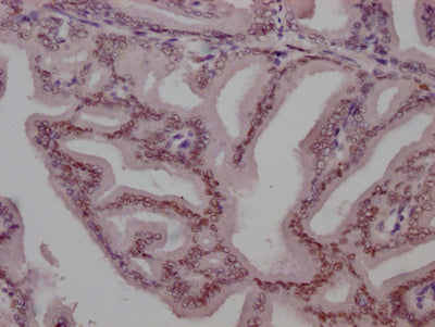 IHC image of RAC07146 diluted at 1:100 and staining in paraffin-embedded human prostate tissue performed on a Leica BondTM system. After dewaxing and hydration, antigen retrieval was mediated by high pressure in a citrate buffer (pH 6.0). Section was blocked with 10% normal goat serum 30min at RT. Then primary antibody (1% BSA) was incubated at 4? overnight. The primary is detected by a Goat anti-rabbit IgG polymer labeled by HRP and visualized using 0.05% DAB.