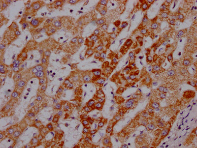 IHC image of RAC07147 diluted at 1:100 and staining in paraffin-embedded human liver cancer performed on a Leica BondTM system. After dewaxing and hydration, antigen retrieval was mediated by high pressure in a citrate buffer (pH 6.0). Section was blocked with 10% normal goat serum 30min at RT. Then primary antibody (1% BSA) was incubated at 4? overnight. The primary is detected by a Goat anti-rabbit IgG polymer labeled by HRP and visualized using 0.05% DAB.