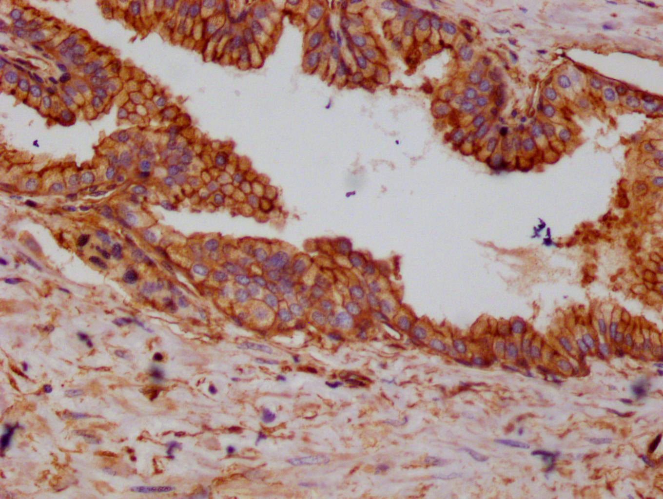 IHC image of RAC07149 diluted at 1:100 and staining in paraffin-embedded human prostate cancer performed on a Leica BondTM system. After dewaxing and hydration, antigen retrieval was mediated by high pressure in a citrate buffer (pH 6.0). Section was blocked with 10% normal goat serum 30min at RT. Then primary antibody (1% BSA) was incubated at 4Â°C overnight. The primary is detected by a Goat anti-rabbit polymer IgG labeled by HRP and visualized using 0.05% DAB.