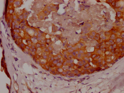 IHC image of RAC07150 diluted at 1:100 and staining in paraffin-embedded human breast cancer performed on a Leica BondTM system. After dewaxing and hydration, antigen retrieval was mediated by high pressure in a citrate buffer (pH 6.0). Section was blocked with 10% normal goat serum 30min at RT. Then primary antibody (1% BSA) was incubated at 4? overnight. The primary is detected by a Goat anti-rabbit IgG polymer labeled by HRP and visualized using 0.05% DAB.