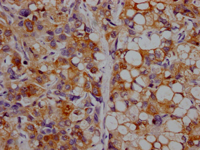 IHC image of RAC07151 diluted at 1:100 and staining in paraffin-embedded human liver cancer performed on a Leica BondTM system. After dewaxing and hydration, antigen retrieval was mediated by high pressure in a citrate buffer (pH 6.0). Section was blocked with 10% normal goat serum 30min at RT. Then primary antibody (1% BSA) was incubated at 4? overnight. The primary is detected by a Goat anti-rabbit IgG polymer labeled by HRP and visualized using 0.05% DAB.