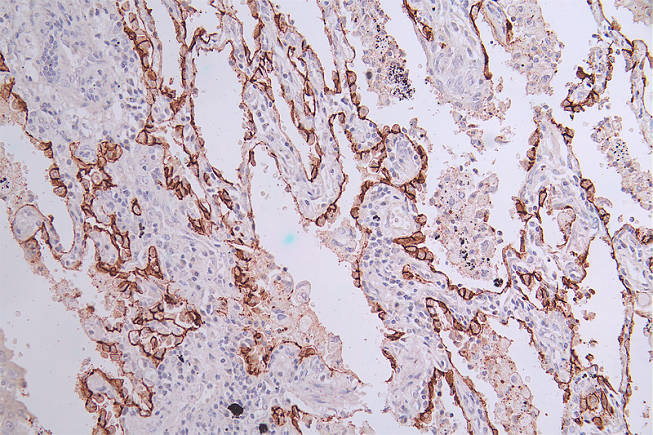 IHC image of RAC07153 diluted at 1:50 and staining in paraffin-embedded human lung cancer performed on a Leica BondTM system. After dewaxing and hydration, antigen retrieval was mediated by high pressure in a citrate buffer (pH 6.0). Section was blocked with 10% normal goat serum 30min at RT. Then primary antibody (1% BSA) was incubated at 4Â°C overnight. The primary is detected by a Goat anti-rabbit polymer IgG labeled by HRP and visualized using 0.33% DAB.