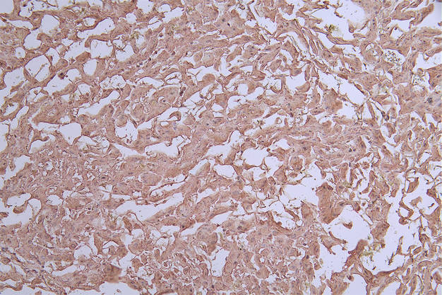 IHC image of RAC07154 diluted at 1:50 and staining in paraffin-embedded human liver cancer performed on a Leica BondTM system. After dewaxing and hydration, antigen retrieval was mediated by high pressure in a citrate buffer (pH 6.0). Section was blocked with 10% normal goat serum 30min at RT. Then primary antibody (1% BSA) was incubated at 4Â°C overnight. The primary is detected by a Goat anti-rabbit polymer IgG labeled by HRP and visualized using 0.71% DAB.
