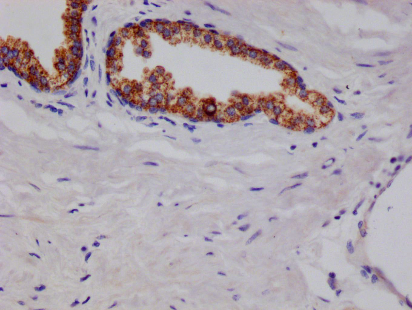 IHC image of RAC07155 diluted at 1:100 and staining in paraffin-embedded human prostate cancer performed on a Leica BondTM system. After dewaxing and hydration, antigen retrieval was mediated by high pressure in a citrate buffer (pH 6.0). Section was blocked with 10% normal goat serum 30min at RT. Then primary antibody (1% BSA) was incubated at 4Â°C overnight. The primary is detected by a Goat anti-rabbit polymer IgG labeled by HRP and visualized using 0.05% DAB.