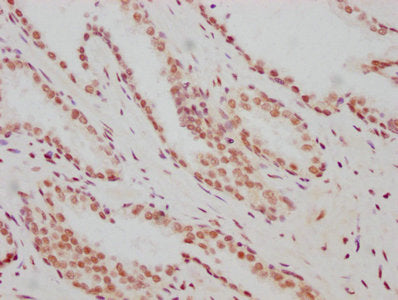 IHC image of RAC07156 diluted at 1:183 and staining in paraffin-embedded human prostate cancer performed on a Leica BondTM system. After dewaxing and hydration, antigen retrieval was mediated by high pressure in a citrate buffer (pH 6.0). Section was blocked with 10% normal goat serum 30min at RT. Then primary antibody (1% BSA) was incubated at 4? overnight. The primary is detected by a biotinylated secondary antibody and visualized using an HRP conjugated SP system.