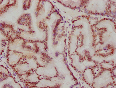 IHC image of RAC07159 diluted at 1:115.5 and staining in paraffin-embedded human prostate tissue performed on a Leica BondTM system. After dewaxing and hydration, antigen retrieval was mediated by high pressure in a citrate buffer (pH 6.0). Section was blocked with 10% normal goat serum 30min at RT. Then primary antibody (1% BSA) was incubated at 4? overnight. The primary is detected by a biotinylated secondary antibody and visualized using an HRP conjugated SP system.