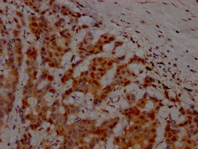 IHC image of RAC07162 diluted at 1:100 and staining in paraffin-embedded human breast cancer performed on a Leica BondTM system. After dewaxing and hydration, antigen retrieval was mediated by high pressure in a citrate buffer (pH 6.0). Section was blocked with 10% normal goat serum 30min at RT. Then primary antibody (1% BSA) was incubated at 4? overnight. The primary is detected by a Goat anti-rabbit IgG polymer labeled by HRP and visualized using 0.05% DAB.