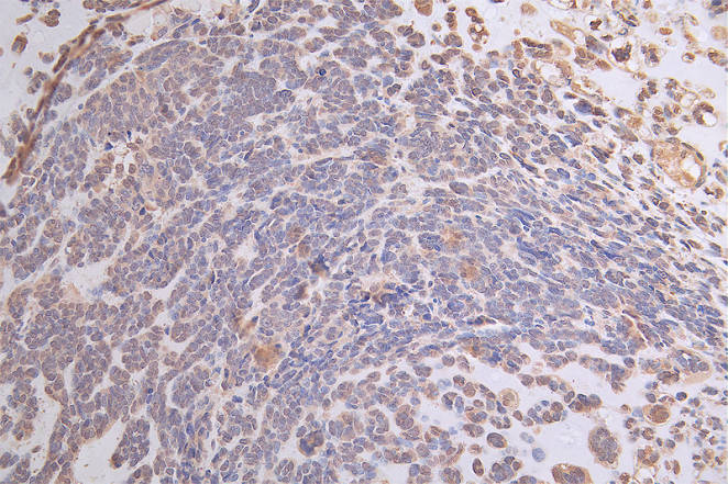 IHC image of RAC07166 diluted at 1:50 and staining in paraffin-embedded human ovarian cancer performed on a Leica BondTM system. After dewaxing and hydration, antigen retrieval was mediated by high pressure in a citrate buffer (pH 6.0). Section was blocked with 10% normal goat serum 30min at RT. Then primary antibody (1% BSA) was incubated at 4Â°C overnight. The primary is detected by a Goat anti-rabbit polymer IgG labeled by HRP and visualized using 0.19% DAB.