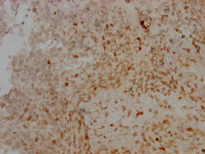IHC image of RAC07169 diluted at 1:100 and staining in paraffin-embedded human cervical cancer performed on a Leica BondTM system. After dewaxing and hydration, antigen retrieval was mediated by high pressure in a citrate buffer (pH 6.0). Section was blocked with 10% normal goat serum 30min at RT. Then primary antibody (1% BSA) was incubated at 4? overnight. The primary is detected by a Goat anti-rabbit IgG polymer labeled by HRP and visualized using 0.05% DAB.
