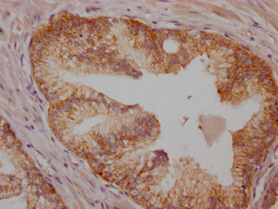 IHC image of RAC07171 diluted at 1:100 and staining in paraffin-embedded human prostate cancer performed on a Leica BondTM system. After dewaxing and hydration, antigen retrieval was mediated by high pressure in a citrate buffer (pH 6.0). Section was blocked with 10% normal goat serum 30min at RT. Then primary antibody (1% BSA) was incubated at 4? overnight. The primary is detected by a Goat anti-rabbit IgG polymer labeled by HRP and visualized using 0.05% DAB.