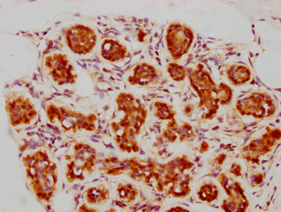 IHC image of RAC07173 diluted at 1:73.75 and staining in paraffin-embedded human breast cancer performed on a Leica BondTM system. After dewaxing and hydration, antigen retrieval was mediated by high pressure in a citrate buffer (pH 6.0). Section was blocked with 10% normal goat serum 30min at RT. Then primary antibody (1% BSA) was incubated at 4? overnight. The primary is detected by a biotinylated secondary antibody and visualized using an HRP conjugated SP system.