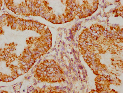 IHC image of RAC07174 diluted at 1:90 and staining in paraffin-embedded human endometrial cancer performed on a Leica BondTM system. After dewaxing and hydration, antigen retrieval was mediated by high pressure in a citrate buffer (pH 6.0). Section was blocked with 10% normal goat serum 30min at RT. Then primary antibody (1% BSA) was incubated at 4? overnight. The primary is detected by a biotinylated secondary antibody and visualized using an HRP conjugated SP system.