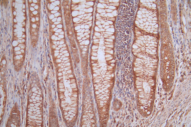 IHC image of RAC07175 diluted at 1:50 and staining in paraffin-embedded human rectal cancer performed on a Leica BondTM system. After dewaxing and hydration, antigen retrieval was mediated by high pressure in a citrate buffer (pH 6.0). Section was blocked with 10% normal goat serum 30min at RT. Then primary antibody (1% BSA) was incubated at 4Â°C overnight. The primary is detected by a Goat anti-rabbit polymer IgG labeled by HRP and visualized using 0.53% DAB.