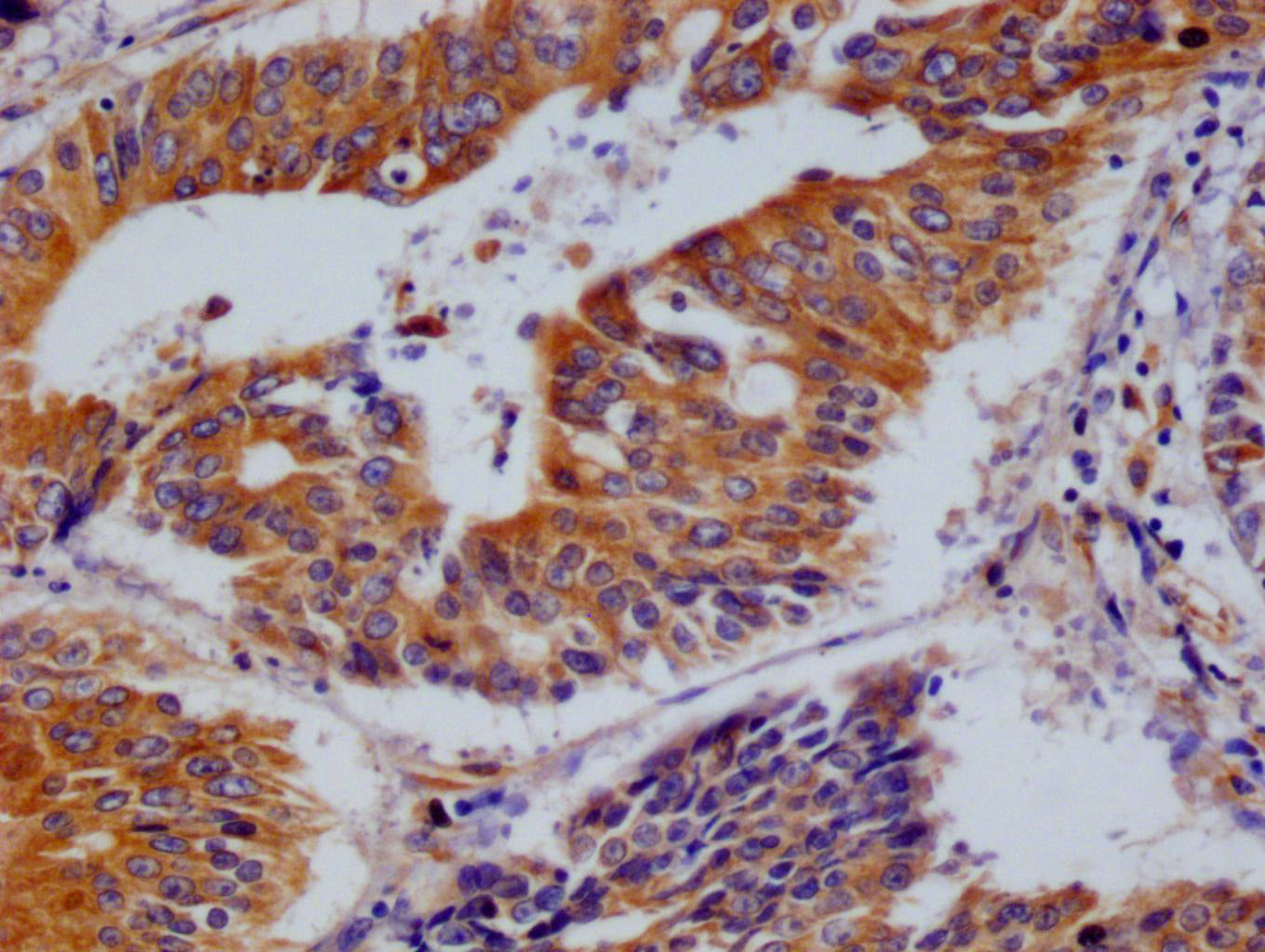 IHC image of RAC07176 diluted at 1:100 and staining in paraffin-embedded human colon cancer performed on a Leica BondTM system. After dewaxing and hydration, antigen retrieval was mediated by high pressure in a citrate buffer (pH 6.0). Section was blocked with 10% normal goat serum 30min at RT. Then primary antibody (1% BSA) was incubated at 4Â°C overnight. The primary is detected by a Goat anti-rabbit polymer IgG labeled by HRP and visualized using 0.05% DAB.