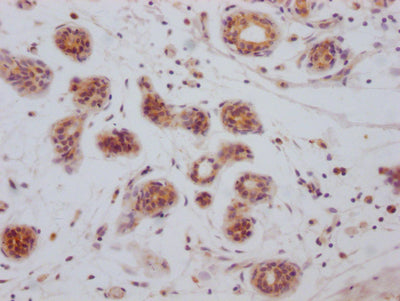 IHC image of RAC07179 diluted at 1:100 and staining in paraffin-embedded human breast cancer performed on a Leica BondTM system. After dewaxing and hydration, antigen retrieval was mediated by high pressure in a citrate buffer (pH 6.0). Section was blocked with 10% normal goat serum 30min at RT. Then primary antibody (1% BSA) was incubated at 4? overnight. The primary is detected by a Goat anti-rabbit IgG polymer labeled by HRP and visualized using 0.05% DAB.